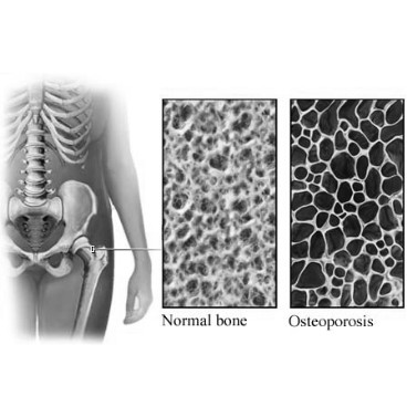 magnetoterapia cura osteoporosi 